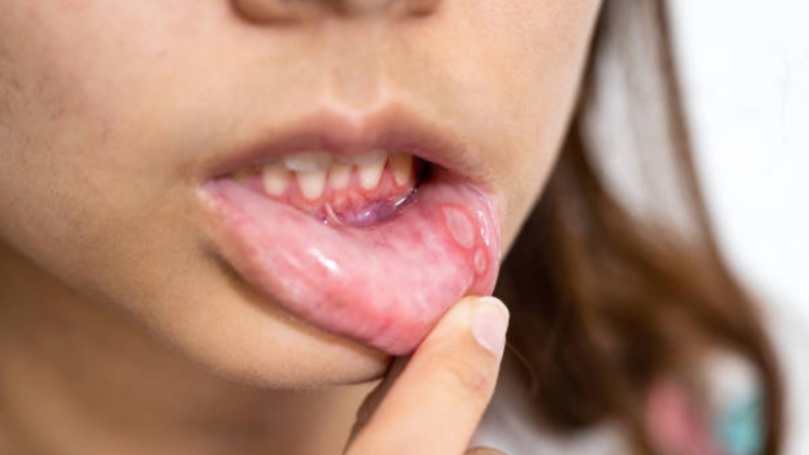 uzmani uyardi 2 haftadan uzun suren agiz yaralari ihmal edilmemeli BUbjg7ms